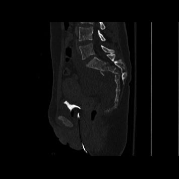 Sagittal CT showing displaced AOSpine C3 transverse sacral fracture with spinopelvic dissociation