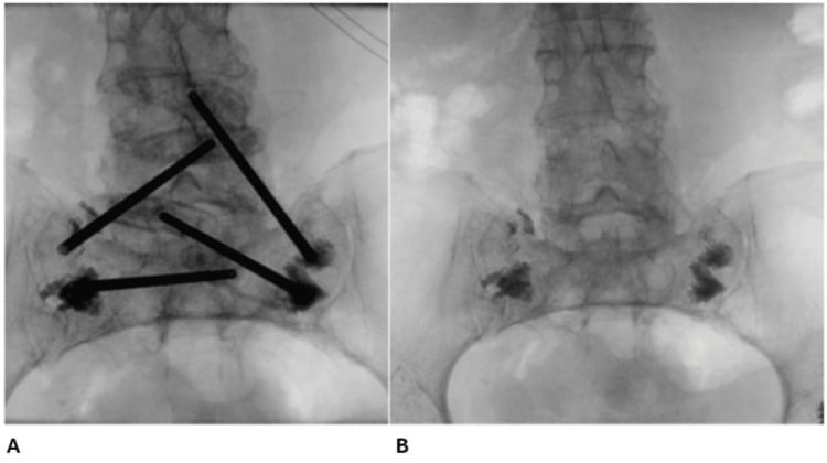 Fluoroscopic sequence showing bilateral sacroplasty needle placement and cement deposition