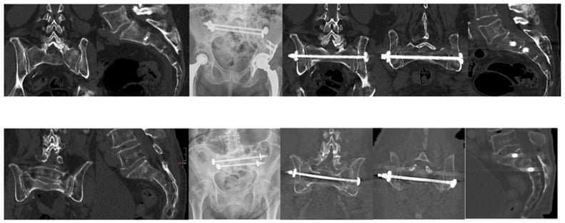 Serial CT and radiographs of two H-type sacral fractures treated with transsacral bar fixation