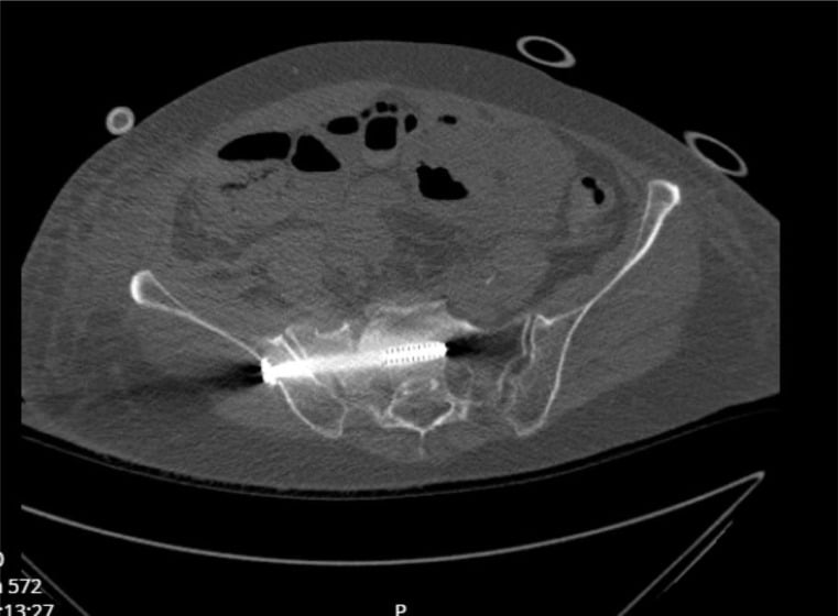 Axial postoperative CT showing an iliosacral screw contained within cancellous bone