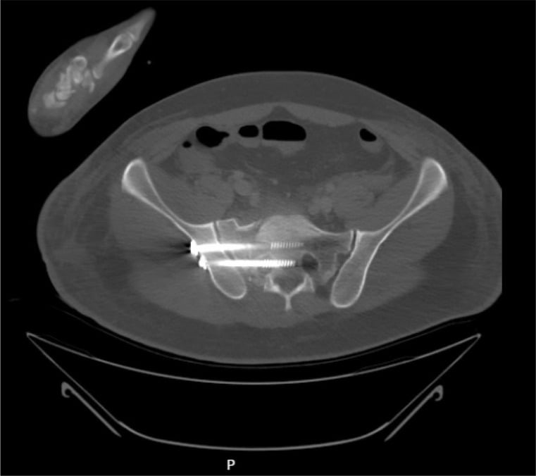 Axial postoperative CT showing a posterior iliosacral screw traversing the right sacral neural foramen