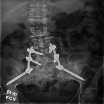 Anteroposterior radiograph of percutaneous L4-to-ilium lumbopelvic fixation