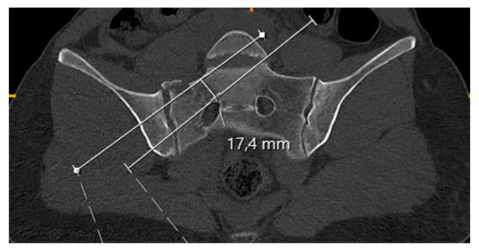 Coronal CT measurement of the narrowest S1 iliosacral screw osseous corridor