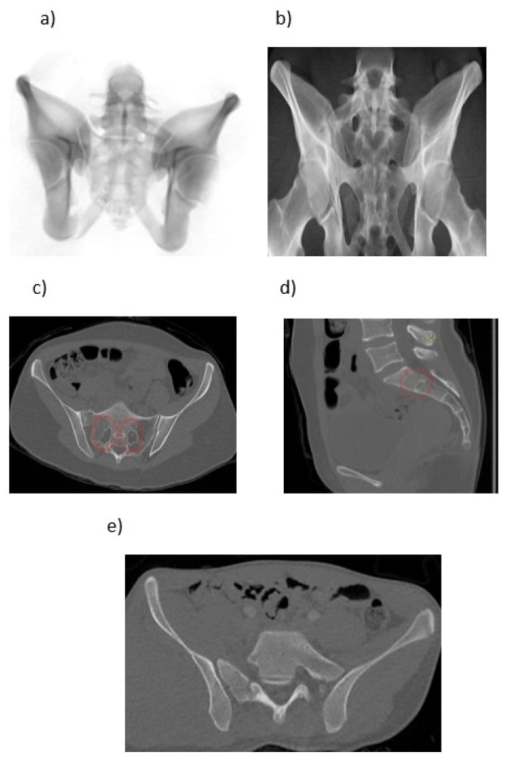 Pelvic outlet radiographs and CT showing the principal qualitative signs of sacral dysmorphism