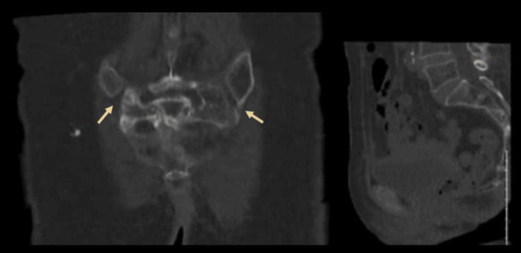 Coronal and sagittal CT showing bilateral sacral insufficiency fracture lines adjacent to the sacroiliac joints