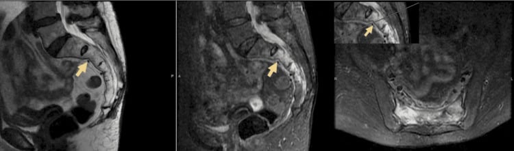 Multiplanar MRI showing marrow oedema and an S2 cortical fracture in sacral insufficiency injury