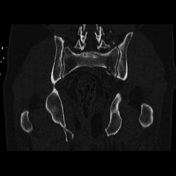 Coronal CT showing bilateral vertical sacral fractures and spinopelvic discontinuity