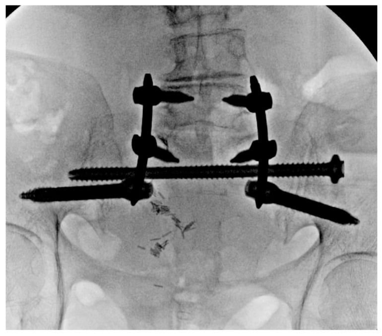 Anteroposterior fluoroscopy of lumbopelvic fixation augmented by transsacral screws in triangular osteosynthesis