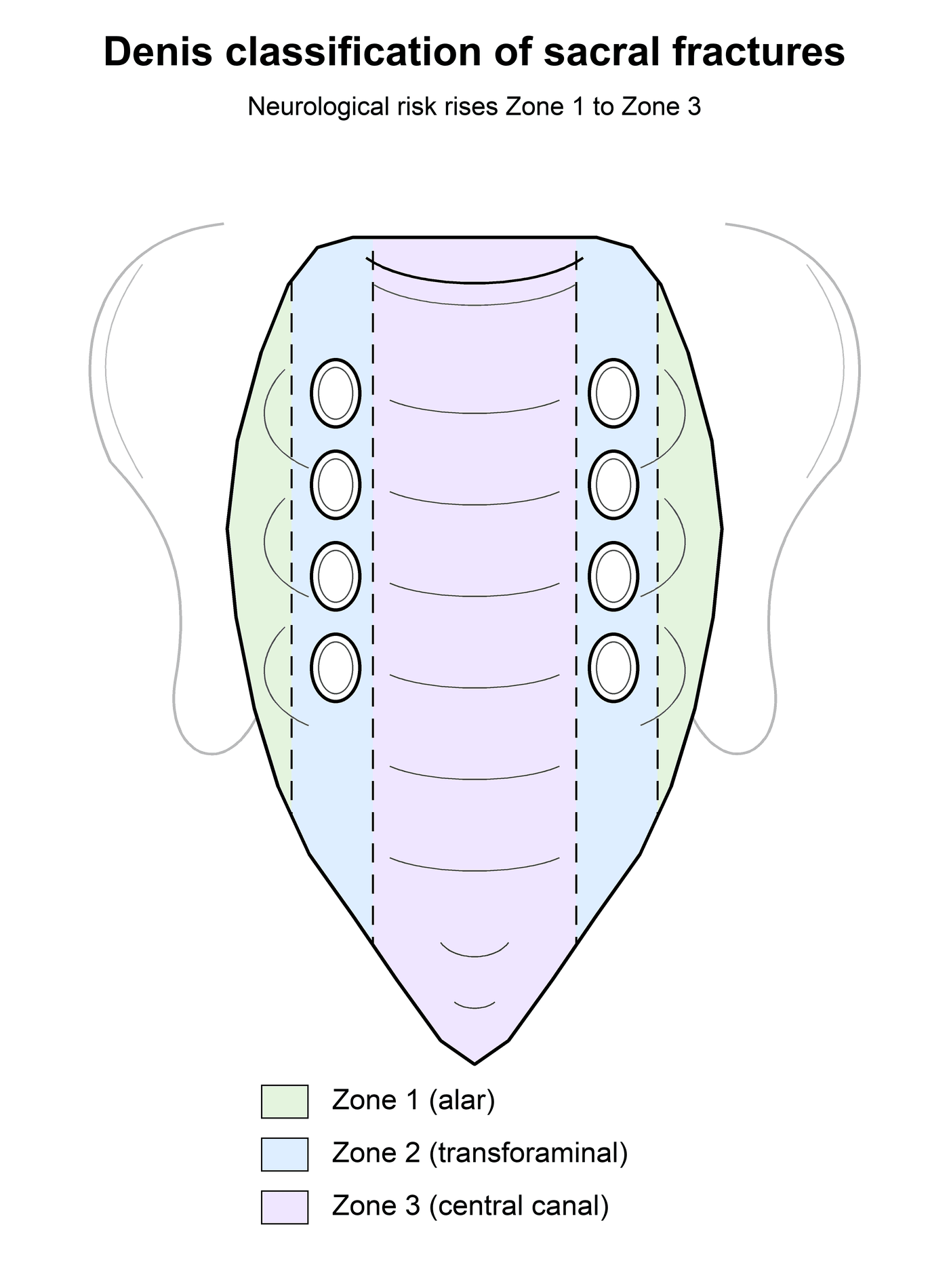 Anterior diagram of the sacrum showing the three Denis zones: zone 1 alar (lateral), zone 2 transforaminal, zone 3 central canal