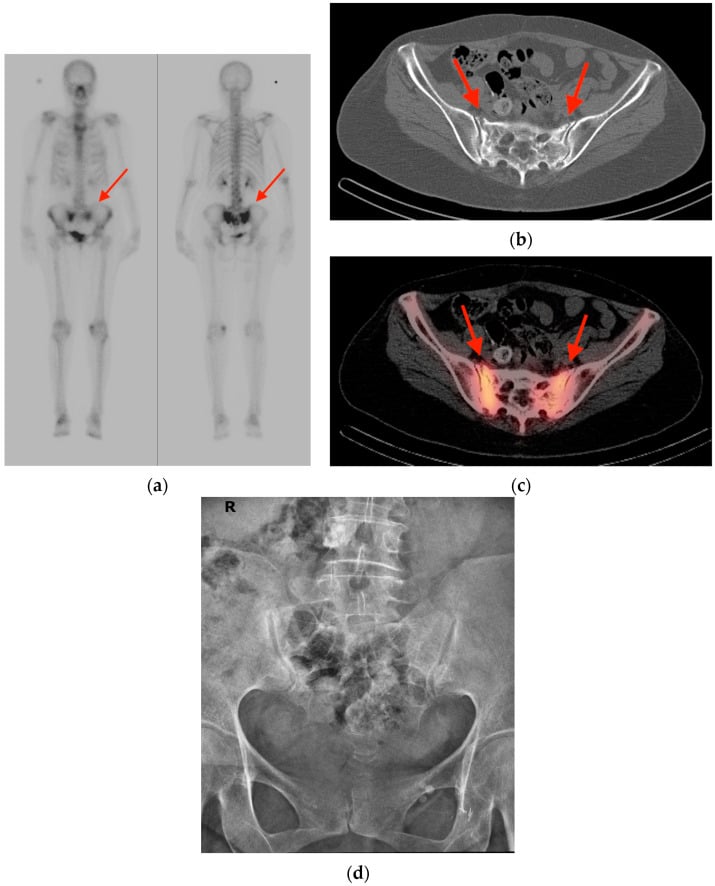 Bone scintigraphy Honda sign with SPECT-CT and MRI confirmation, contrasted with a sacral metastasis