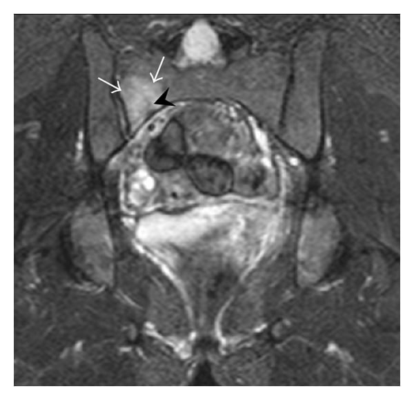 Coronal STIR MRI of the sacrum showing marrow oedema and a fracture line in the right sacral ala