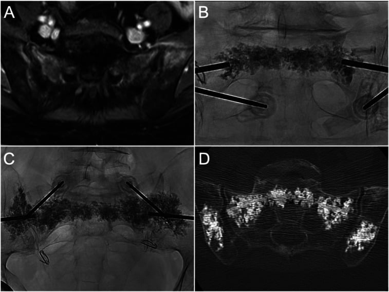 Coronal MRI of bilateral sacral ala fractures with matching fluoroscopy and CT of cement filling both alae and the iliac wings