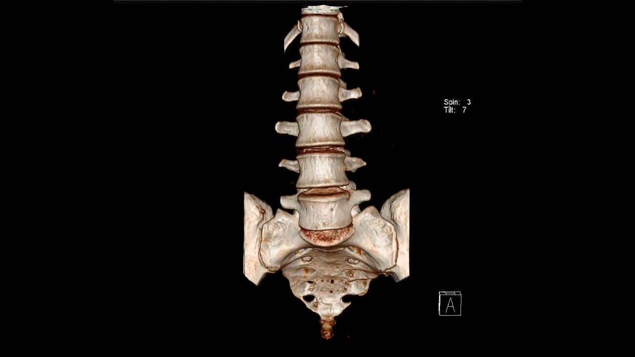 3D CT of the sacrum (anterior view) showing the sacral alae, foramina and body graded by the FFP classification - the regions where the H-pattern fracture runs