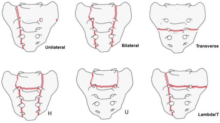 Line diagrams of sacral insufficiency patterns: H-type, U-type, lambda/T-type and unilateral vertical