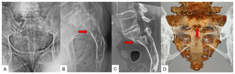 AP and lateral pelvis radiographs called normal, with sagittal CT and 3D CT showing a sacral insufficiency fracture