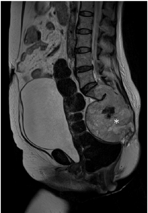 Sagittal T2-weighted MRI showing a large bright mass replacing the sacrum, marked with a star.