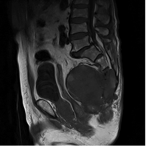MRI of pelvis showing a large sacral mass extending into soft tissue and compressing the rectum.
