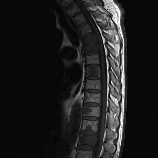 Spinal MRI showing multiple vertebral metastatic lesions with cord compression at the fourth thoracic vertebra.