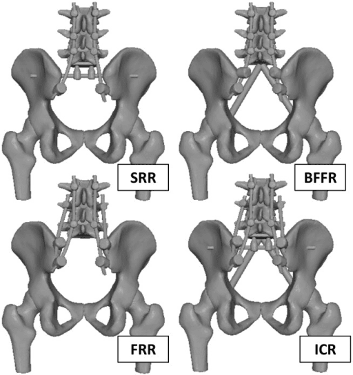 Illustrations of four different spinopelvic reconstruction constructs after sacrectomy.