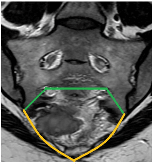 Coronal MRI of the sacrum with coloured lines marking planned osteotomy and resection margins.