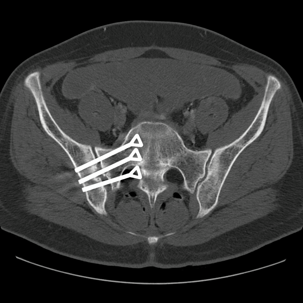Axial pelvic CT showing three parallel triangular titanium implants placed across the right sacroiliac joint in a minimally invasive lateral transiliac fusion, with the normal left sacroiliac joint shown for comparison.
