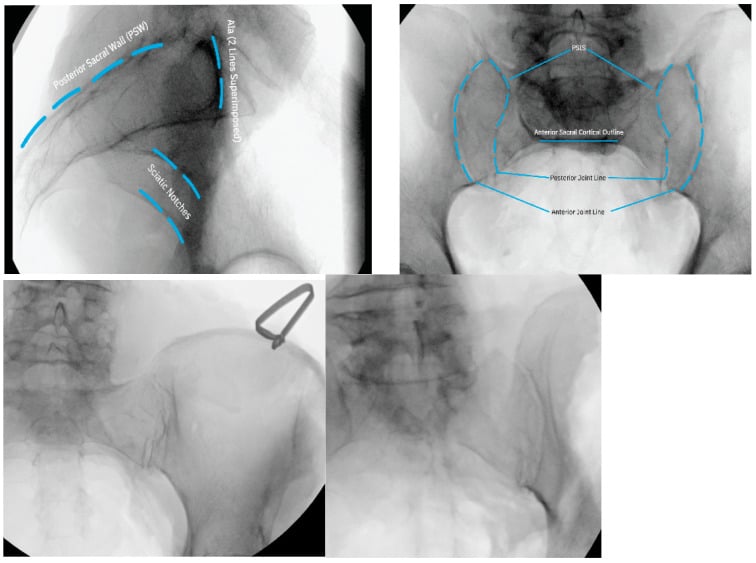 Four fluoroscopic panels, two labelled with the posterior sacral wall, ala, sciatic notches, PSIS, anterior sacral cortical outline and anterior and posterior joint lines