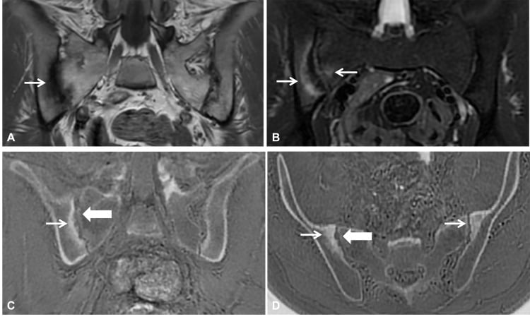 Four MRI panels of the sacroiliac joints, abnormal on the image left: conventional sequences in A and B, ZTE sequences with CT-like bone contrast in C and D, with thin and thick arrows