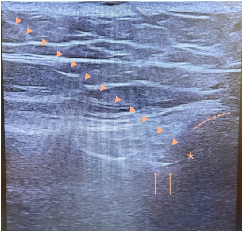 Ultrasound-guided intra-articular sacroiliac injection, the needle advancing in an oblique transverse plane towards the posterior joint cleft, with arrowheads along the needle and an asterisk at the joint space