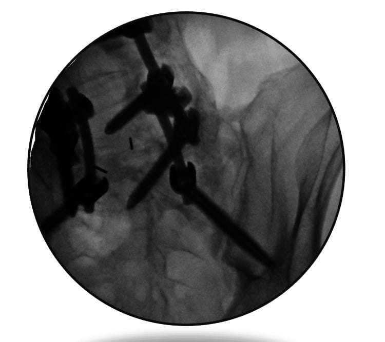 Sacroiliac fluoroscopy showing screw-and-rod hardware in situ