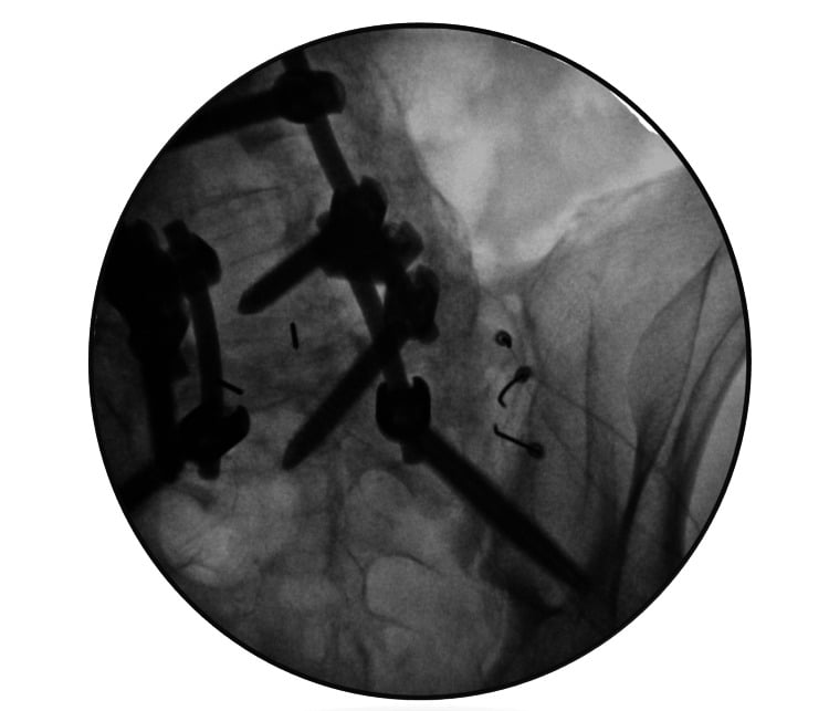 Fluoroscopy showing radiofrequency needle tips placed beside existing screw-and-rod instrumentation