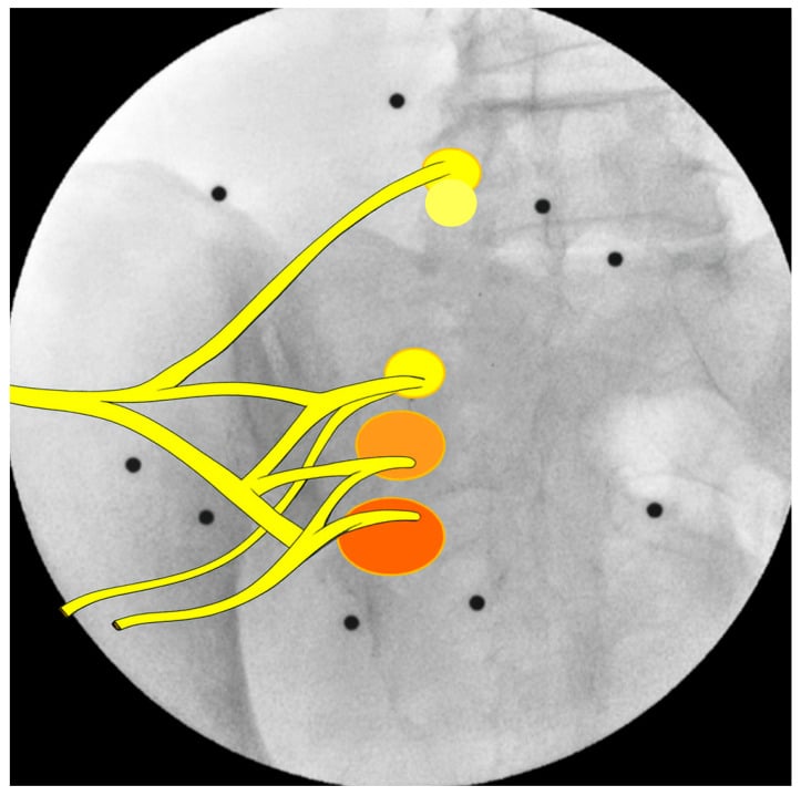 Fluoroscopic image overlaid with schematic nerve branches running to a column of graded target points
