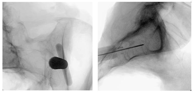 Two fluoroscopic views during reaming of the sacroiliac fusion implant track