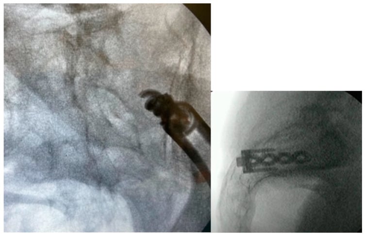Two fluoroscopic views showing the implant inserter at the joint and a fenestrated implant in place