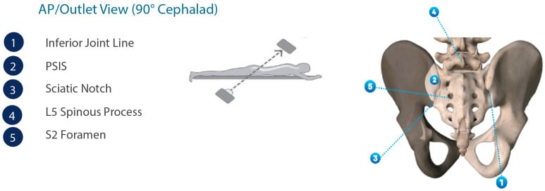 Labelled AP/outlet rendering of the pelvis marking the inferior SI joint line, PSIS, sciatic notch, L5 spinous process and S2 foramen