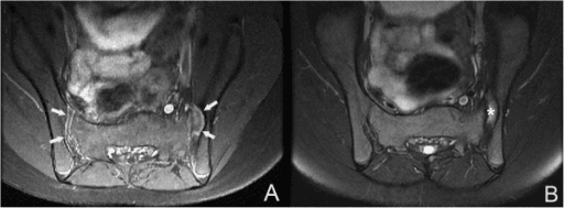 Axial contrast-enhanced MRI of the sacroiliac joints in a child with spondyloarthropathy showing bilateral synovial enhancement and an iliac-side erosion.