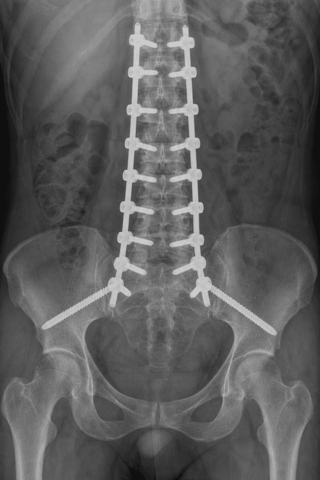 AP radiograph of a long lumbosacral construct with bilateral pedicle screws and iliac fixation