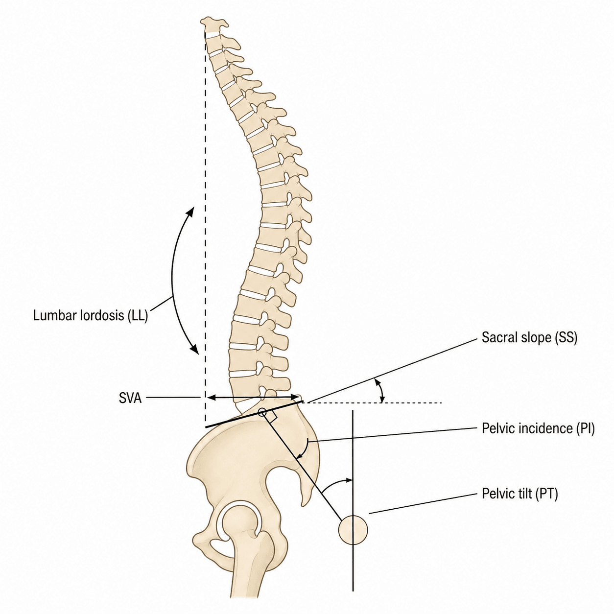 Lateral spine and pelvis diagram of the spinopelvic sagittal-balance parameters: pelvic incidence, pelvic tilt, sacral slope, lumbar lordosis and sagittal vertical axis.
