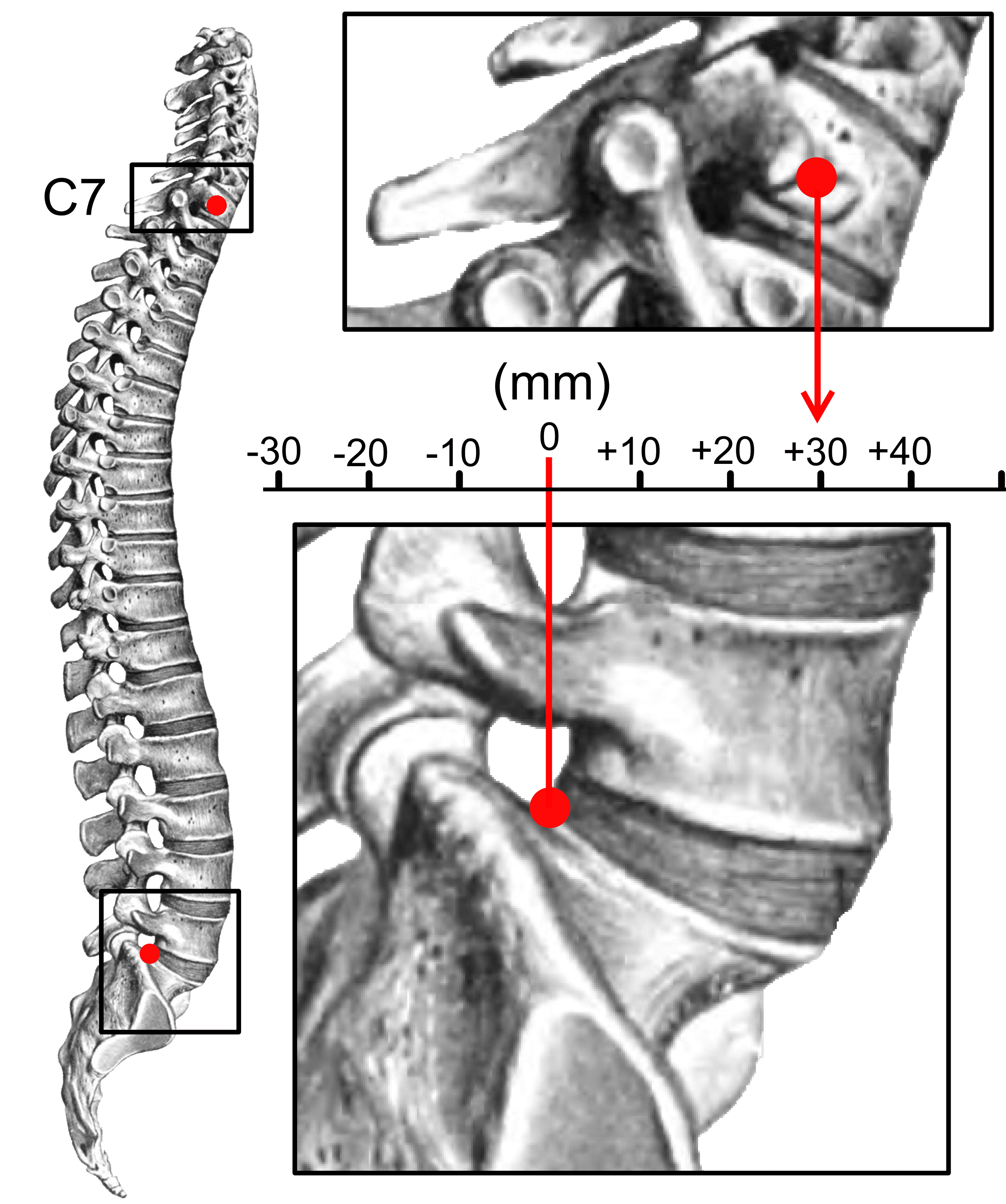 Illustrated measurement of sagittal balance with C7 and S1 reference points and a millimetre scale for the sagittal vertical axis