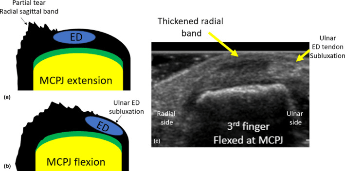 Diagrams and dynamic ultrasound of a partial radial sagittal band tear, with ulnar ED subluxation in MCP flexion