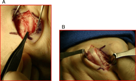 Two operative photographs, panels A and B, of a radial sagittal band rupture and its repair through a dorsal incision over the MCP joint
