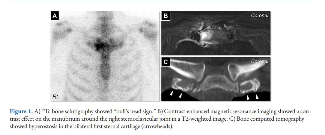 Composite figure showing technetium bone scintigraphy with a bull's head pattern of uptake at the sternoclavicular joints, plus coronal MRI and CT of the sternoclavicular region.