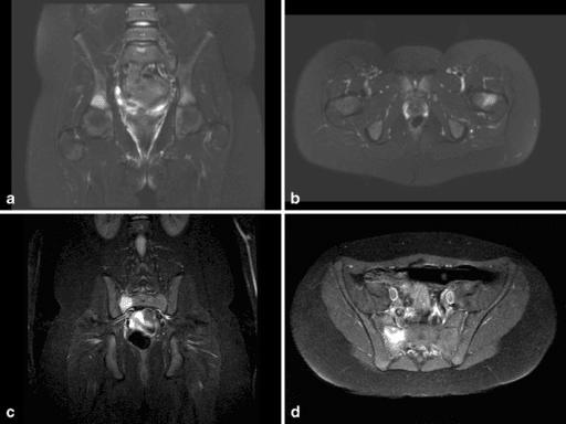 Fat-suppressed T2 MRI of pelvis with high signal in acetabulum and femoral neck