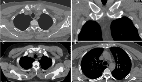 CT images of sternum and sternoclavicular joints showing bone erosions