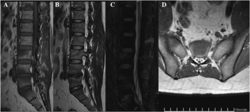 Sagittal MRI of lumbar spine with signal change in several vertebral bodies