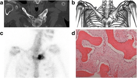 Composite CT, bone scan and histology images of sternocostoclavicular hyperostosis