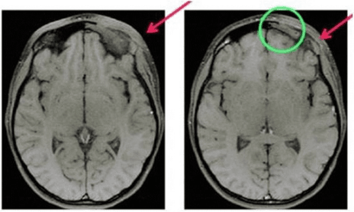 MRI of head showing inflammatory change around the left orbit
