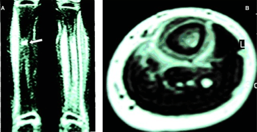 Coronal STIR MRI of tibiae showing bright marrow oedema with an arrow at a biopsy site
