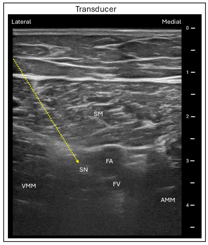Ultrasound image of the adductor canal labelled with sartorius, vastus medialis, adductor magnus, saphenous nerve and femoral vessels.