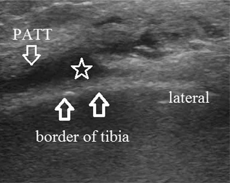Short-axis ultrasound of the medial proximal tibia showing fluid in the pes anserine bursa and thickened pes anserine tendons.