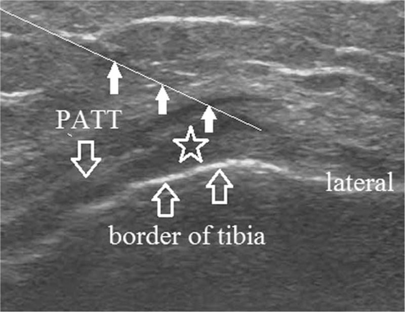 Ultrasound-guided injection view of the pes anserine bursa at the medial proximal tibia, with the needle path and tendon thickening labelled.